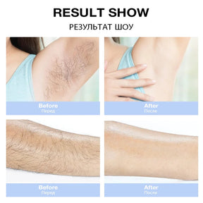 Intense pulse light(Hair removal)